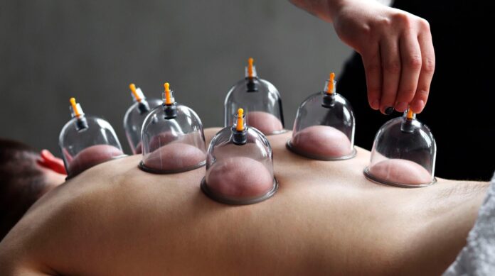 cupping therapy cupping therapy